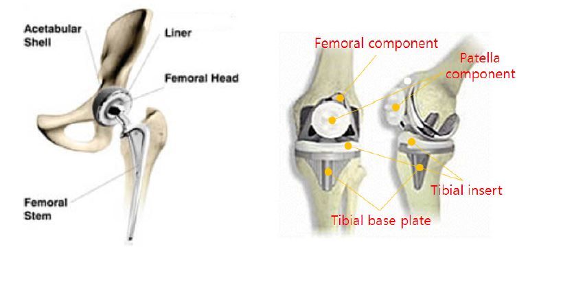 인공관절로 대치된 고관절 및 슬관절의 해부학적 구조