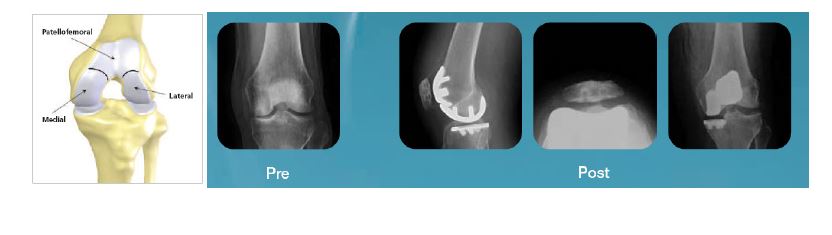 무릎 인공관절 치환수술 사례