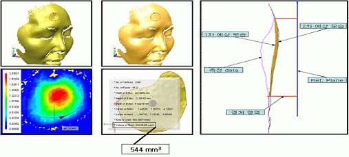 3D 스캐너를 이용한 흉터 부피 측정방법