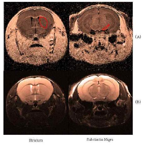 (A) 자화전이도 영상에서 히스토그램 변이 구성요소를 이용한 정량적 측정을 위한 선조체(Striatum)과 흑질체(Substantia Nigra)의 위치도(붉은 원). (B) 자화전이 도 영상을 구성할 때 사용된 T2 강조 영상