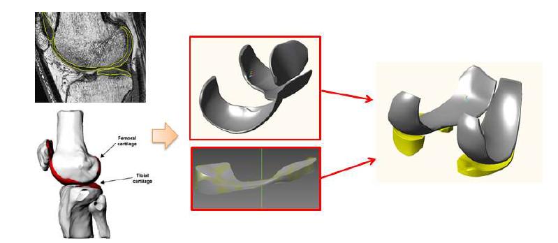 영상이미지(CT)를 기반으로 하여 반월상 연골 모델 개발