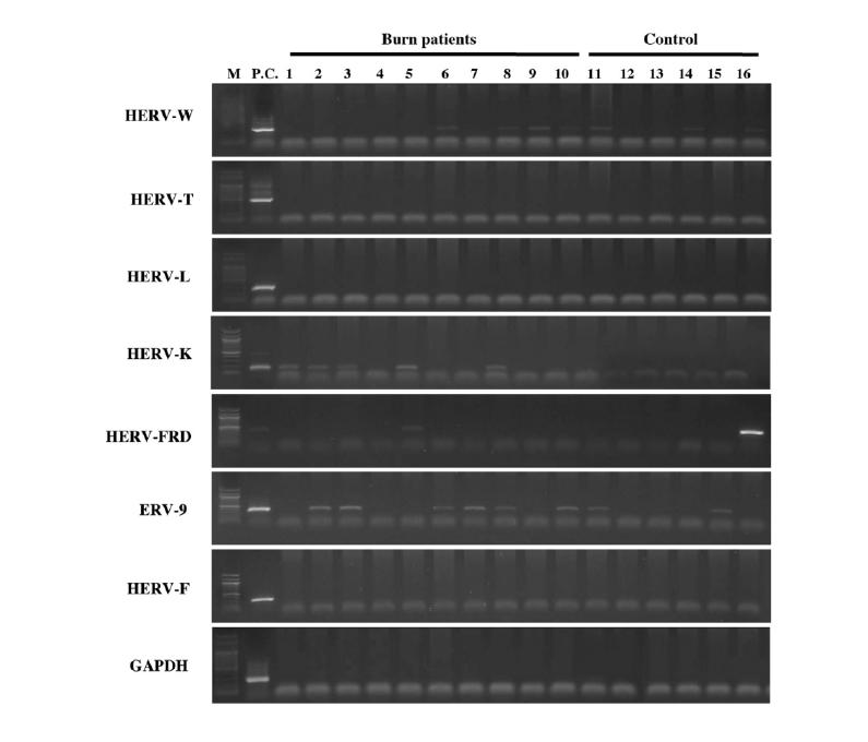 The RT-PCR analysis of seven HERV transcripts in the plasma samples from patients with burns and form normal individuals