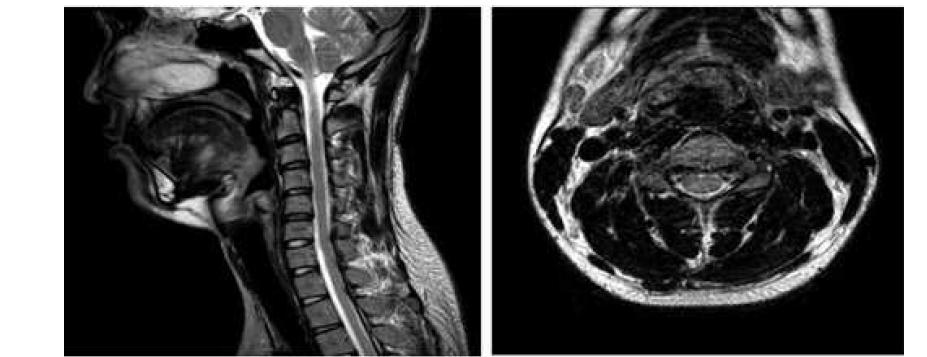 전기 척수신경손상 환자의 일반 MRI소견