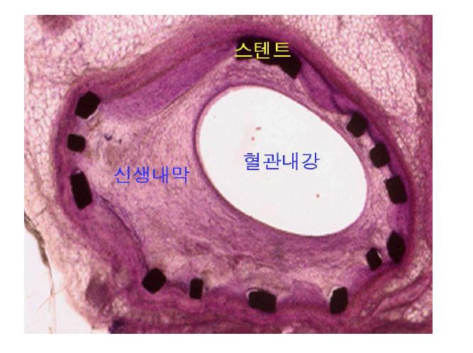 신생내막 형성에 의한 스텐트 내 재협착으로 혈관내강이 좁아짐