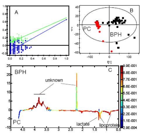 Cross- validated parameters generated from O- PLS- DA comaprison of NMR spectra of plasma obtained from PC patients and BPH subjects after EDTA peaks being removed