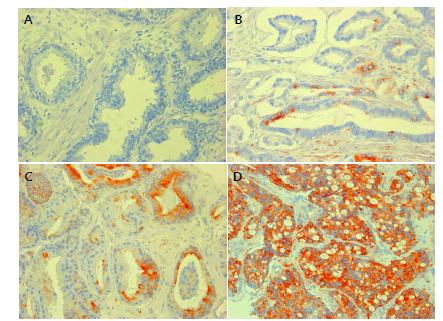 Expression of resistin (RETN) in prostate cancer and benign prostatic hyperplasia