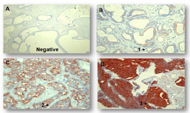 Immunohistochemical staining of HOXA10 in BPH (A) and prostate cancer (B-D)