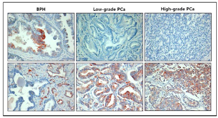 전립선비대증과 전립선암 환자 조직에서 KLOTHO의 immunohistochemistry 분석