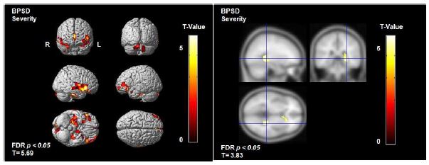 그림 2. NPI (행동심리증상에 따른 뇌의 회색질, 백질의 위축정도)