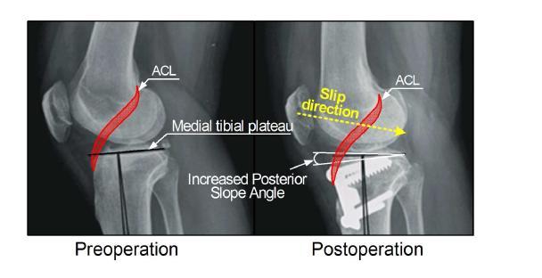 Sagittal plane of change in slip direction with increase of posterior tibial slope angle after high tibial osteotomy (HTO)