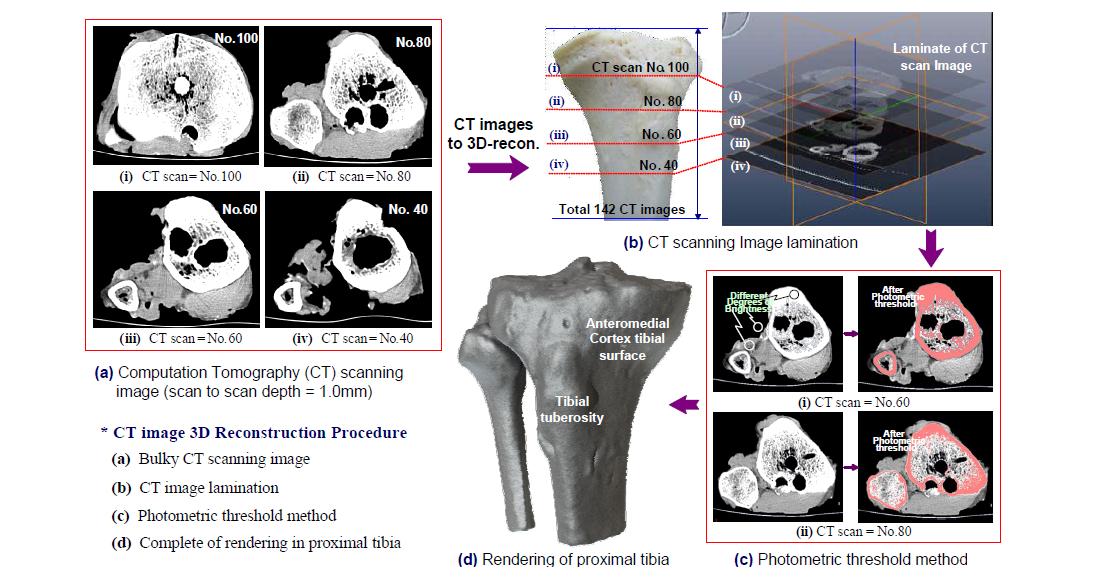 Illustration of 3-dimensional CT image reconstruction on proximal tibia using computer assisted surgeries