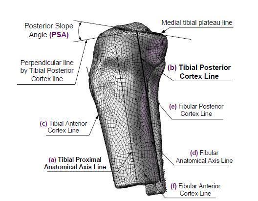 Various references lines for exact measurements of Posterior Slope Angle (PSA())