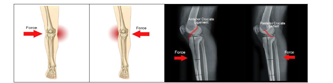 슬관절 인대별 부상 메커니즘