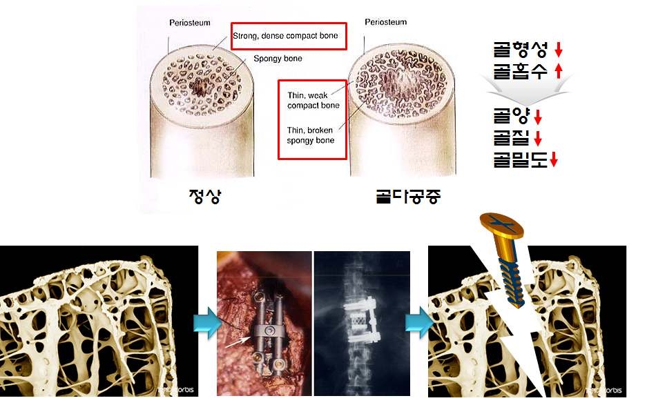 그림 4. 골다공증 보유환자 맞춤형 골이식재 개발의 필요성