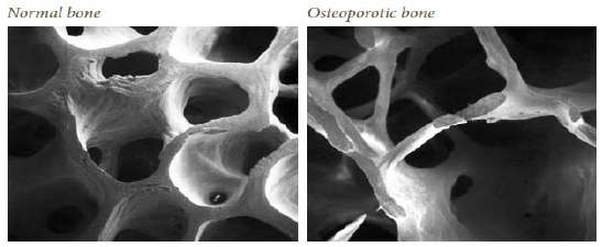 정상 뼈(왼쪽)와 골다공증 뼈(오른쪽)의 상태 비교