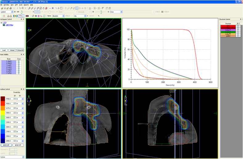 Fig. 6. IMRT plan based on CBCT using Monaco® system.