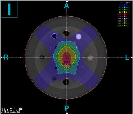 Fig. 7. 3D Conformal plan based on CBCT data.