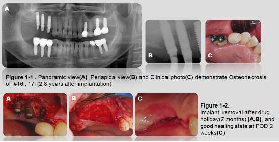 Fig. 2. 상악골 골 이식후 식립한 임플란트에서 발생한 BRONJ의 치료 증례