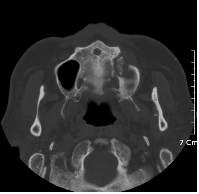Fig. 5. 신장이식후 발생한 골다공증을 치료하기 위해 bisphosphonate를 투여한 환자에서 상악골에 발생한 BRONJ