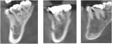 Fig. 7. CBCT에서 관찰되는 하악골 내부의 변화