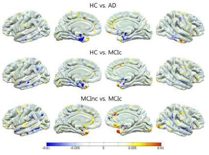 초기 치매 환자 그룹 가운데 MCI converter와 MCI non-converter간 대뇌 피질의 두께 차이를 가시화