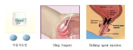 대표적인 요실금 치료 방법.