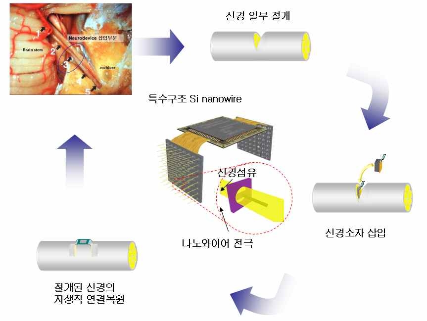 나노와이어 기반 신개념 지능형 신경소자의 임상적용