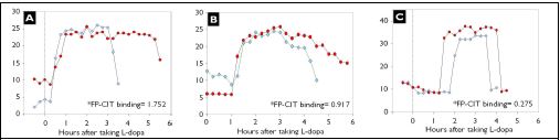 Fig 6. Three representative cases showing changes in L-dopa response after drug holiday with iv amantadine