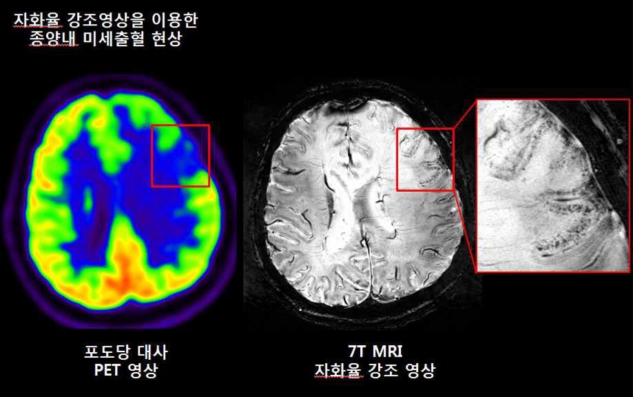 그림 111. 자화율 강조영상을 이용한 종양 내 미세출혈 현상 및 포도당 대사 영상과 비교