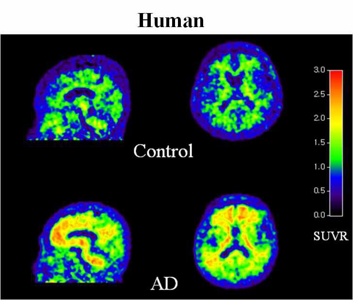 그림 31. 정상인 (상)과 알쯔하이머 환자 (하)의 [C-11]PIB 영상의 비교 알쯔하이머 환자의 경우 회백질의 섭취도가 일반인보다 매우 높으며, 이것은 [C-11]PIB가 아밀로이드 반에 잘결합되었음을 의미한다