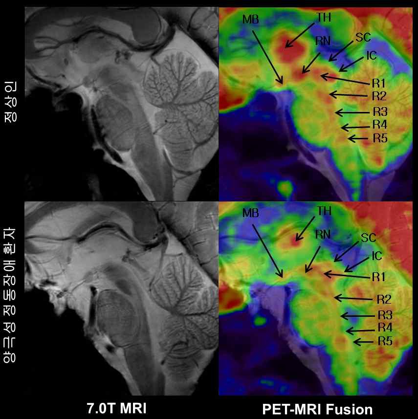 그림 62. 정상군과 정동장애환자의 융합영상