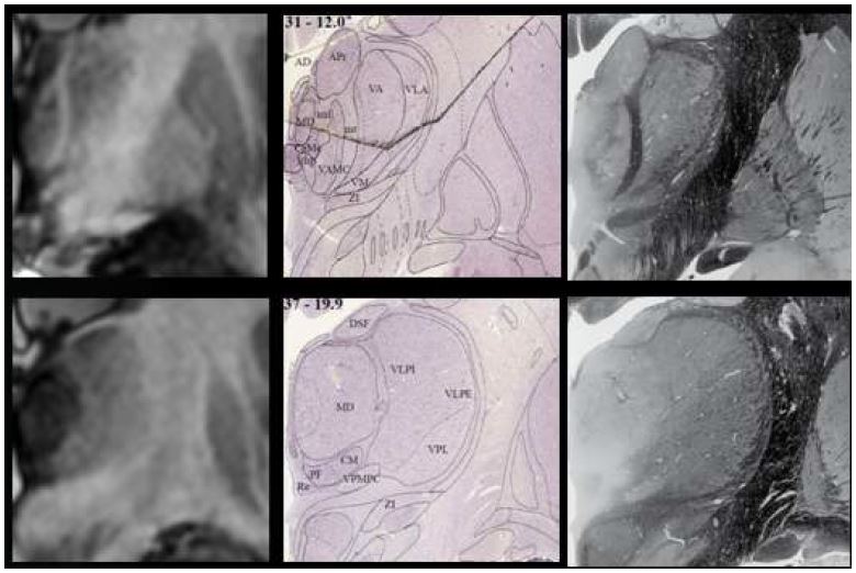 그림 64. 시상의 7T MRI, Nissle 염색, 백색질 염색 사진