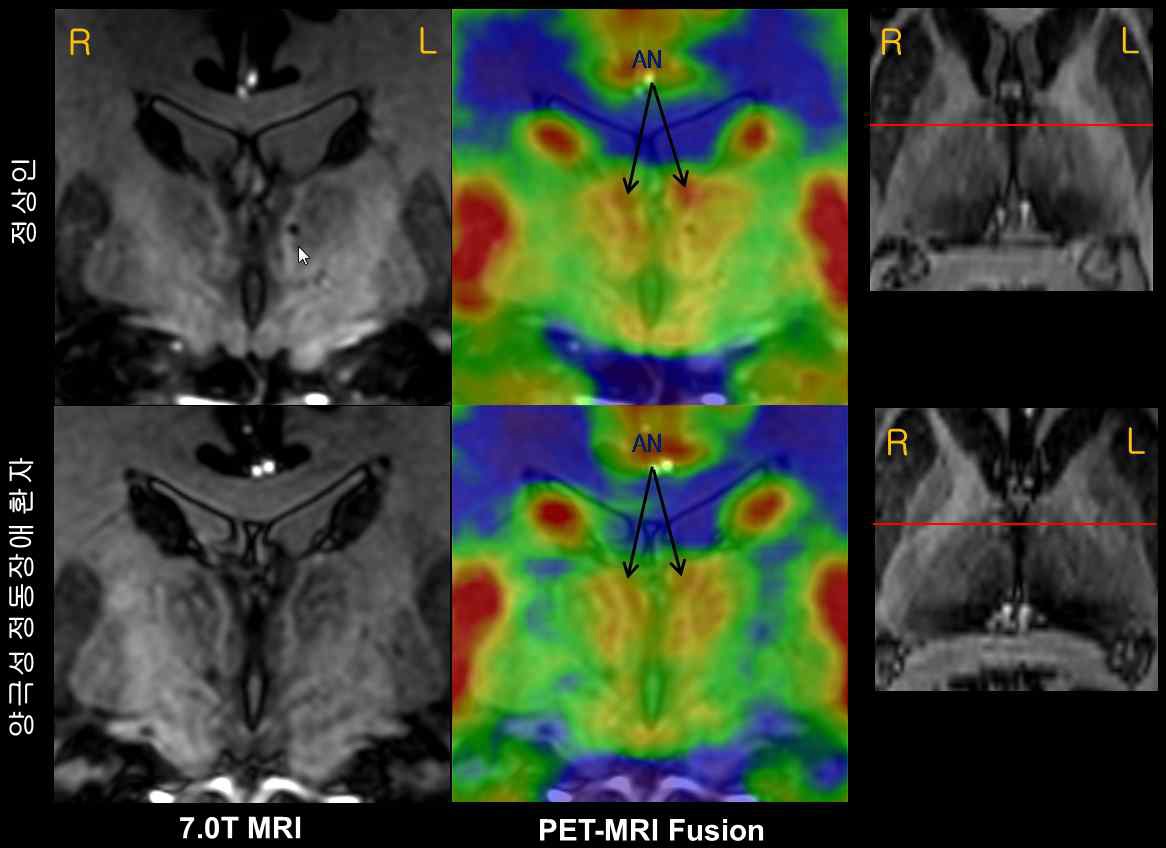 그림 75. 정상군과 정동장애환자의 시상(AN) 복합영상