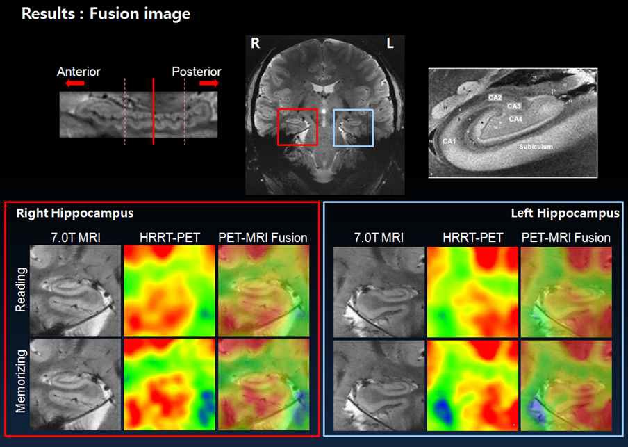 그림 83. 숫자를 읽는 작업을 했을 때와 외우는 작업을 했을 때의 좌, 우 해마 몸통부분의 포도당 대사 복합영상