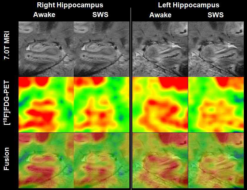 그림 86. 깨어있을 때와 SWS단계에서 좌우 해마의 복합영상다고 알려져 있다