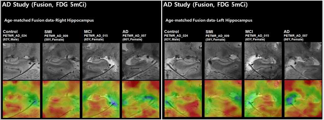 그림 87. AD, MCI, SMI 환자군 및 정상군에서 좌우 해마의 포도당 대사 복합영상