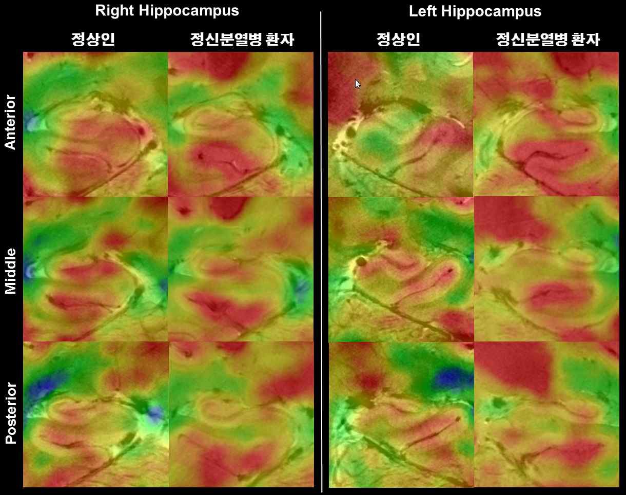 그림 88. 정상군과 조현병 환자의 좌우 해마 앞쪽, 중간, 끝쪽의 복합영상