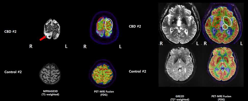 그림 91. CBD 환자와 정상군에서의 포도당 대사 복합영상 비교