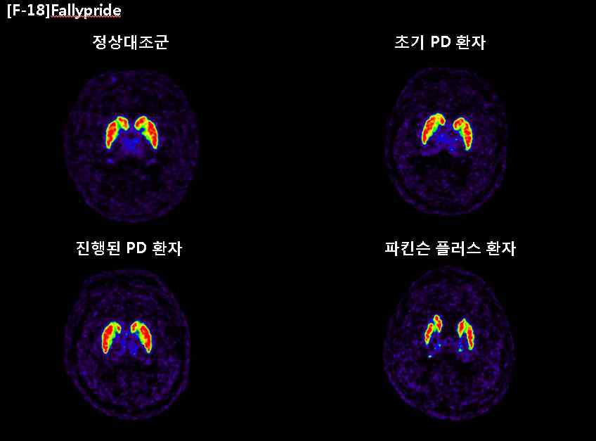 그림 99. Fallypride를 이용한 도파민 수용체 영상
