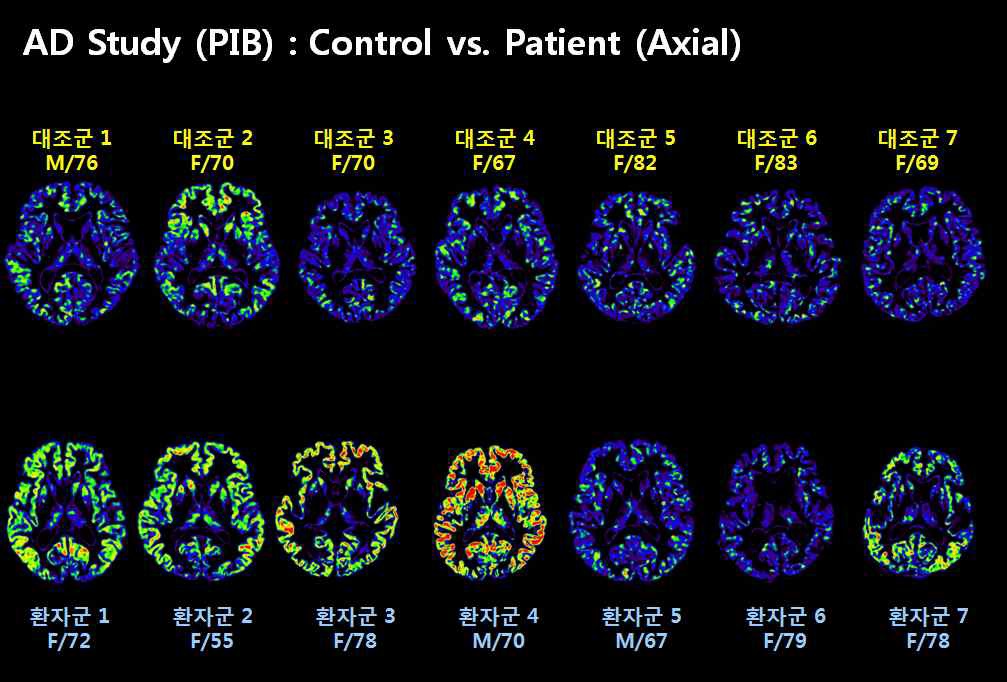 그림 101. AD 환자군과 정상대조군에서의 아밀로이드 반점 영상