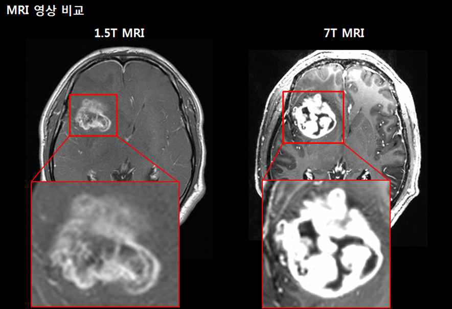 그림 109. 1.5T MRI와 7T MRI에서 뇌종양 비교 영상