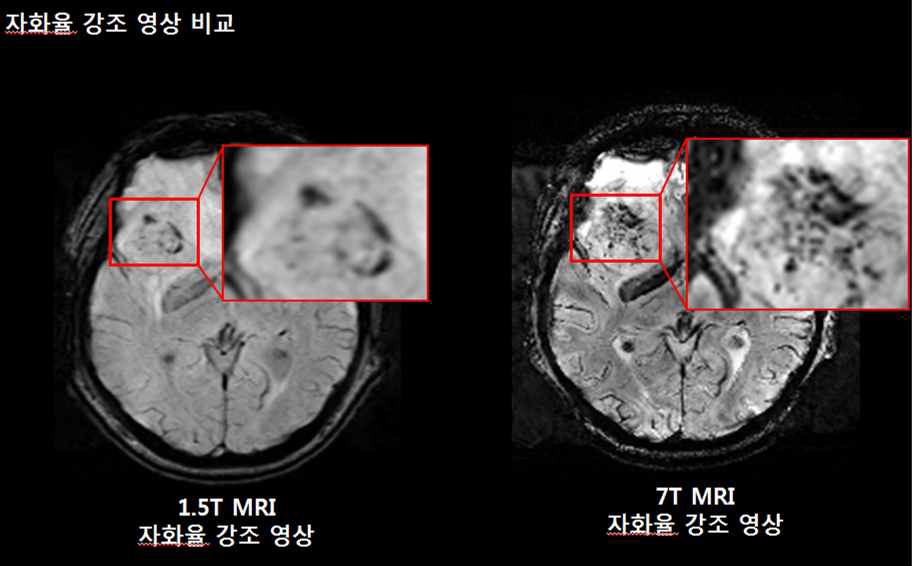 그림 110. 1.5T MRI와 7T MRI에서 뇌종양 부위의 자화율 강조 영상 비교