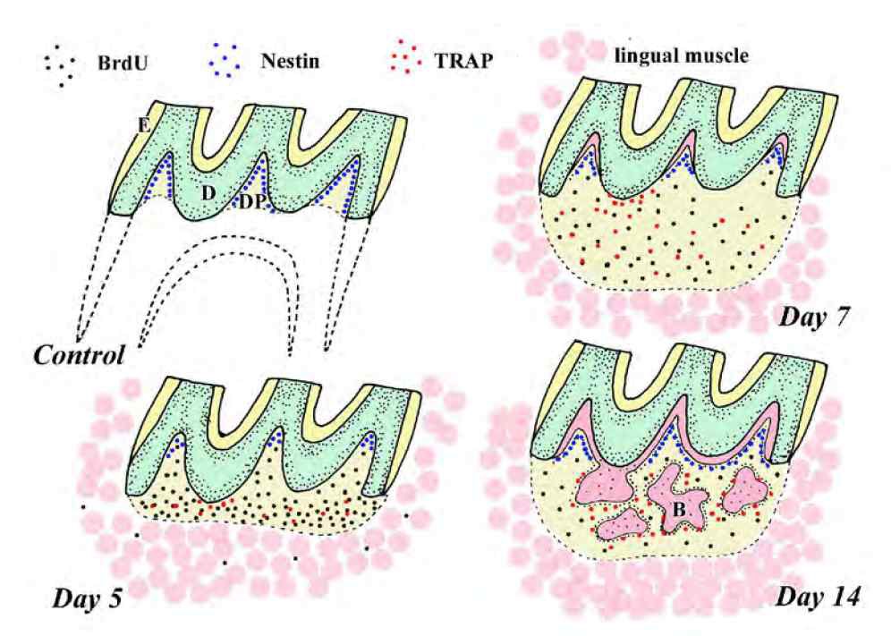 그림 3. 자가치아이식 결과 이식 5일 후 약간의 TRAP 양성반응을 보이는 osteoclast가 관찰되었고, 치 아의 상아질(D) 표면의 치수(DP)에 nestin 양 성반응을 보이던 neural crest cell이 감소하였 고, 전반적으로 세포의 증식이 관찰되었음. 이 식 7일 후 osteoclast가 보다 많이 관찰되었으 며, 새로운 상아질이 기존 상아질 표면에 침착 되었음을 알 수 있었음. 이식 14일 후 광범위 하게 삼차상아질과 뼈(B)가 재생되었으며, 뼈 주위로 osteoblast와 osteoclast가 다수 관찰되 었음.