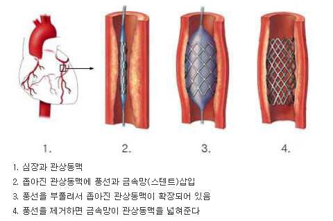 그림 5. 스텐트를 사용한 관상동맥 확장술