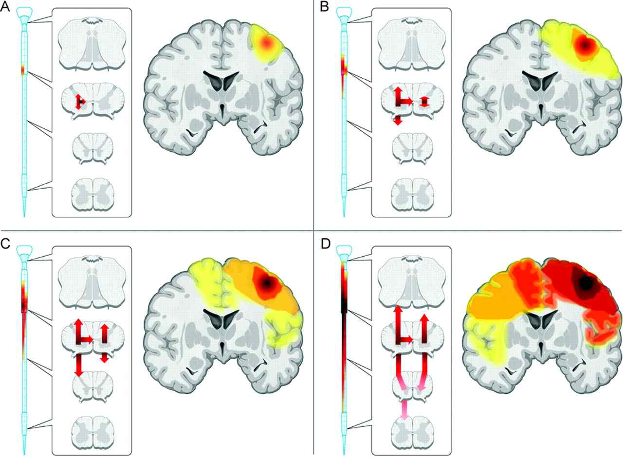 Figure. An idealized model of the natural history of ALS (A) Focal onset, (B) Early spread, (C)Continued outward, (D) Advanced spread