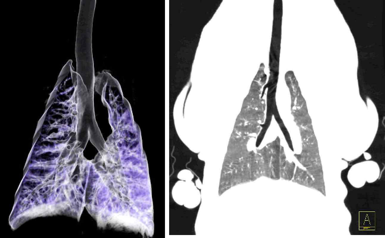 MDCT 촬영을 통해 얻어진 폐의 3차원 영상