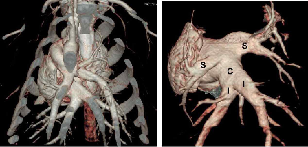 폐 혈관의 3차원 영상 (S) 좌상폐정맥, (C) 공통우하폐정맥, (I) 좌/우하폐정맥