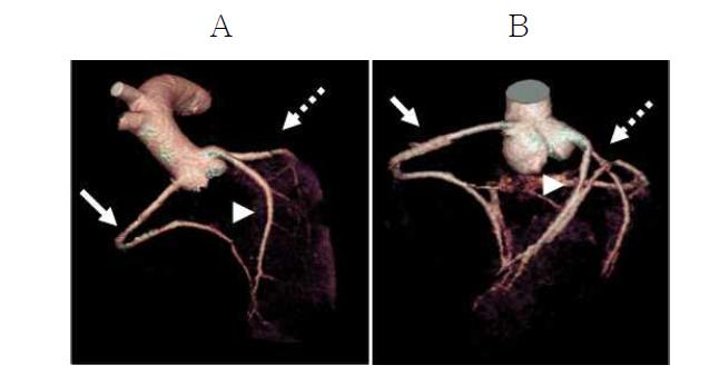 일반돼지 (A)와 미니돼지 (B)의 MDCT를 이용한 관상동맥 측정치 비교