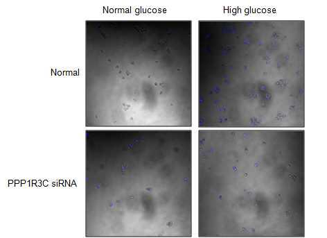 고혈당 상태의 암세포 증식에 PPP1R3C의 관련성 확인