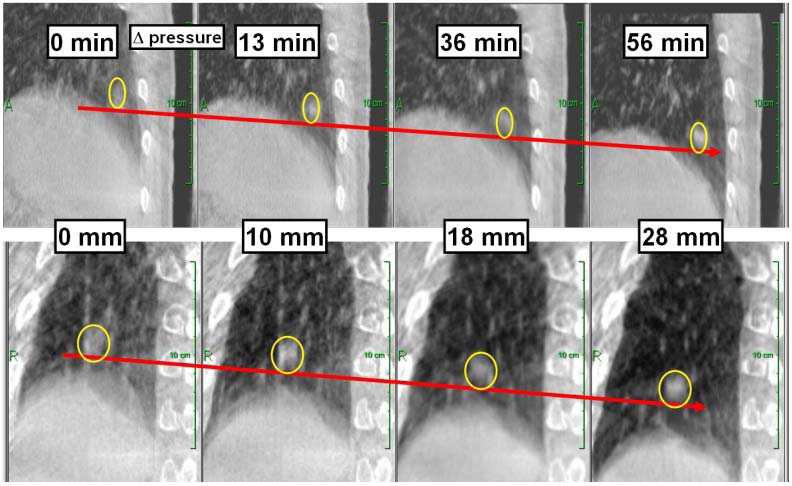 Fig 1. Example of intrafraction motion for a lung SBRT patient as measured by cone beam CT at Stanford.